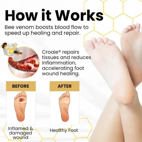 Bee Venom Diabetic Foot Ulcer Spray