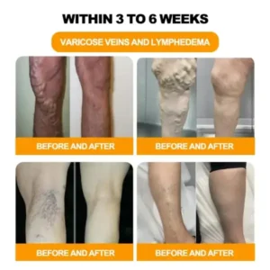 Bee Venom Lymphatic Drainage & Slimming Foot SoakBeads