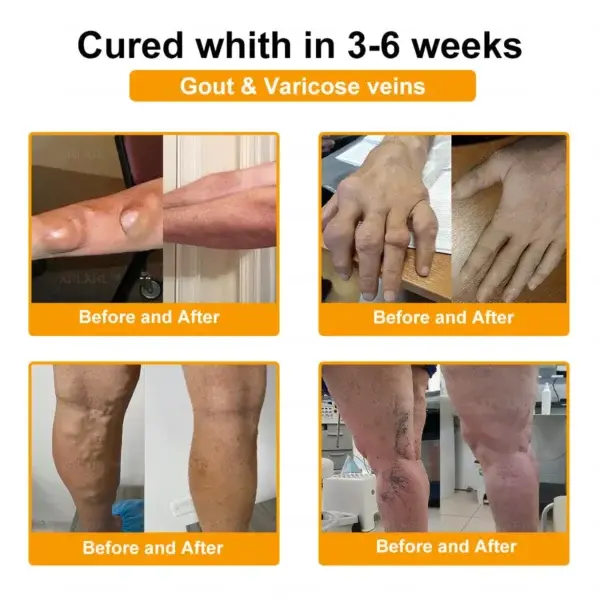 Bee Venom Pain-Relief Bone Healing Spray