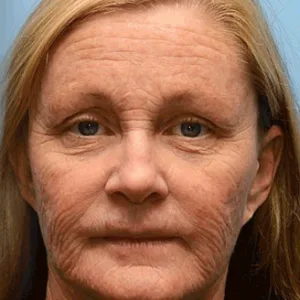 Botox Bee Venom Wrinkle Removal Cream