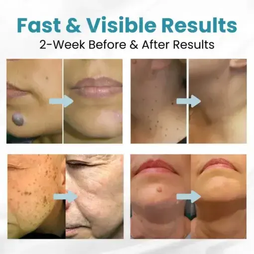 Non-Invasive Mole and Wart Removal Laser Pen