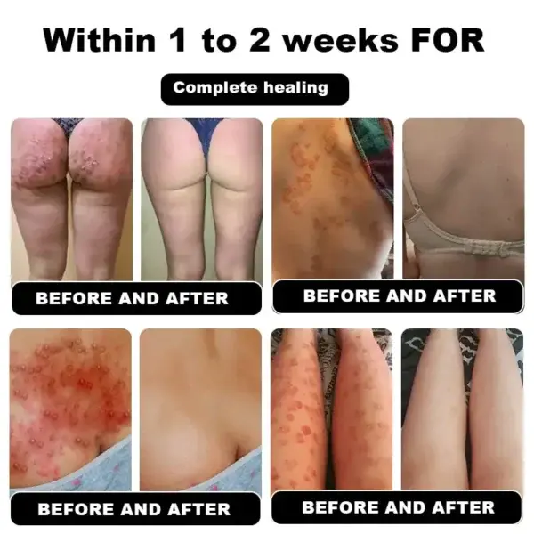 Psoriasis Cure Cream