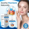Timilk® MagnesiumHerb Psoriasis Relief Cream