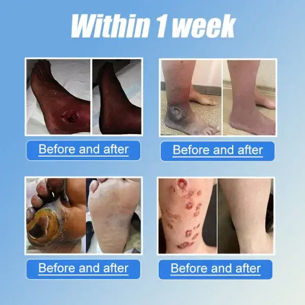 VitaGluco Diabetes Treatment Cream