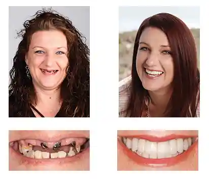 3D Dentures