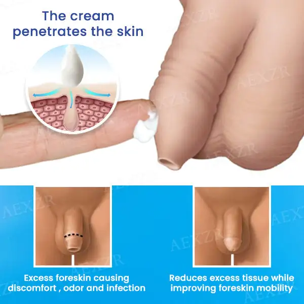 Foreskin Cream Solution - Image 3