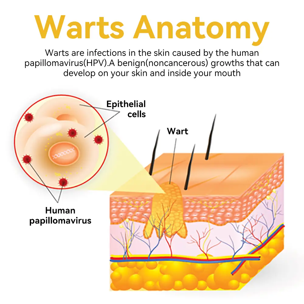 Bee Venom Wart & Moles Removal Cream - Image 12