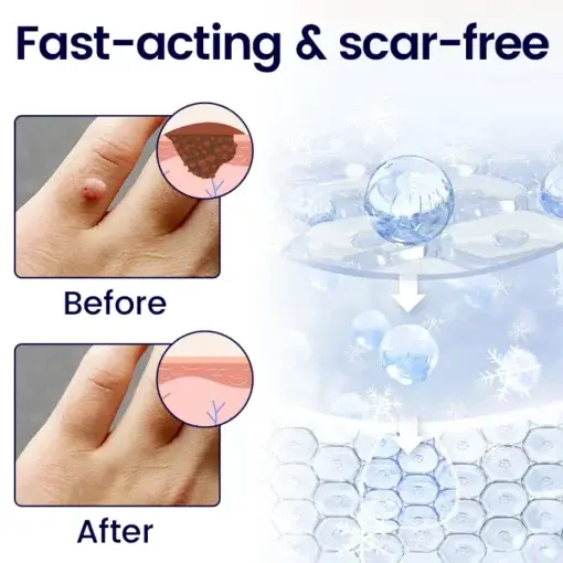 WartFreez Cryo Wart Removal Spray - Image 2