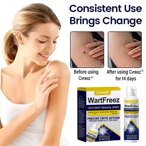 WartFreez Cryo Wart Removal Spray - Image 5