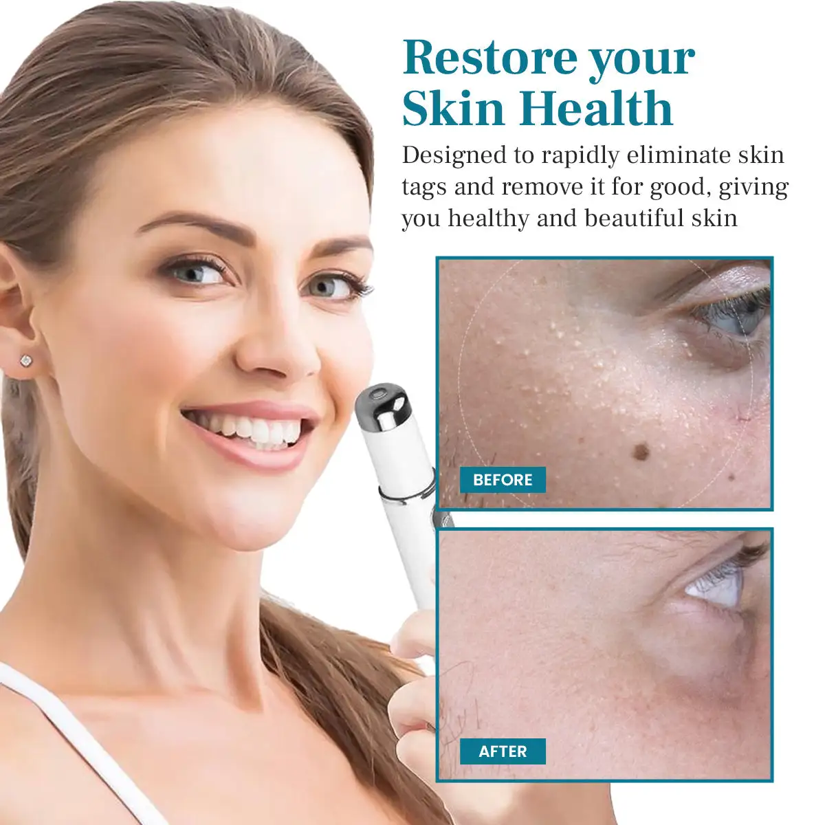 LumeSkin Mole and Wart Removal Laser Pen - Image 6