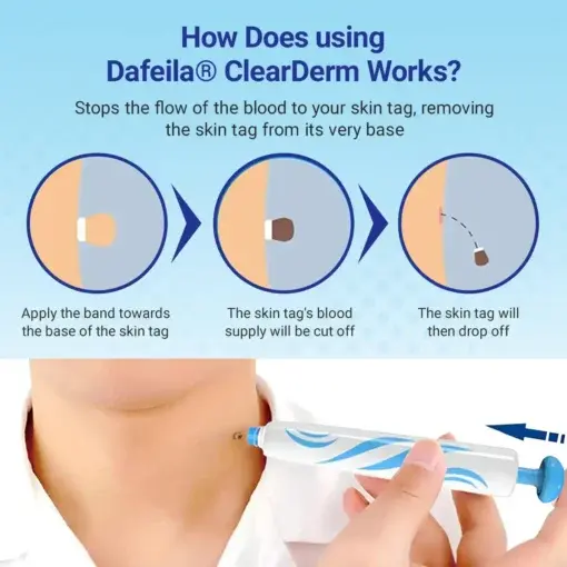 ClearDerm At-home Skin Tag Removal Pen - Image 2