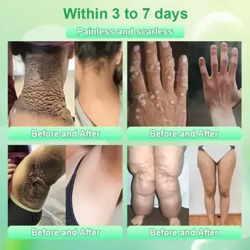 Purifying Exfoliating Gel for Acanthosis Nigricans - Image 2