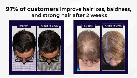 LOVILDS Natural Hair Regrowth Spray - Image 5