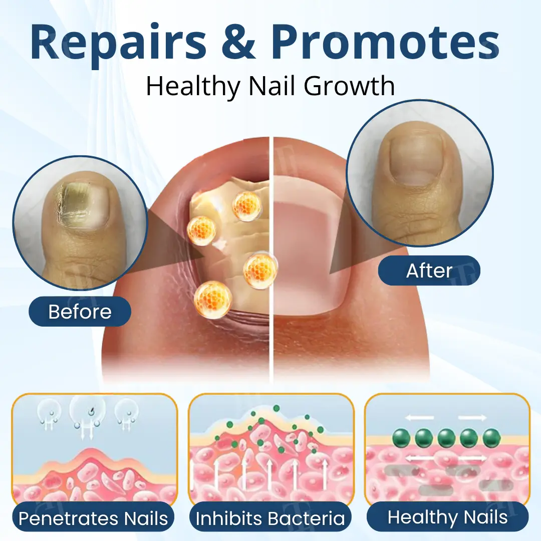 MycoShield Pro Fungal Nail Patches - Image 5