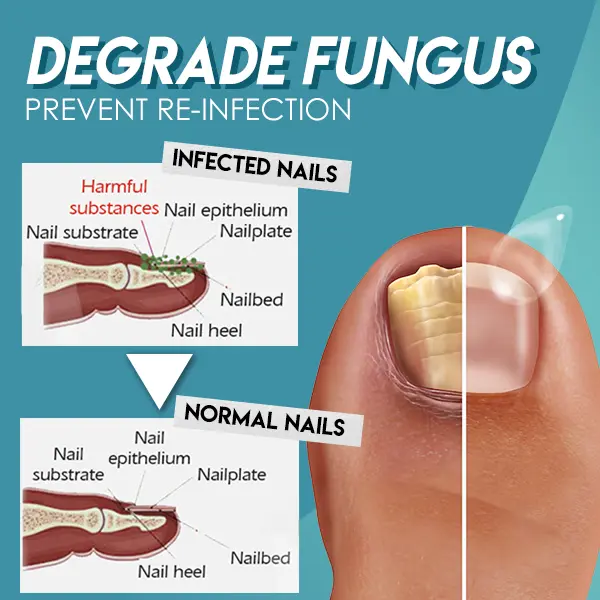 Fungus Nail Repair Gel - Image 3