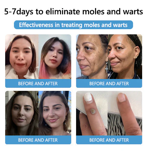 PRO Bee Venom Mole and Wart Treatment Cream - Image 6