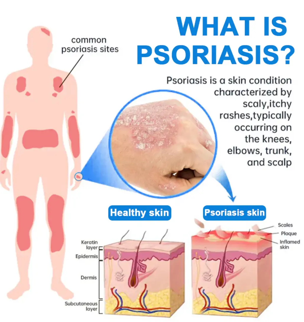 Magnesium Herbal Psoriasis Spray - Image 6