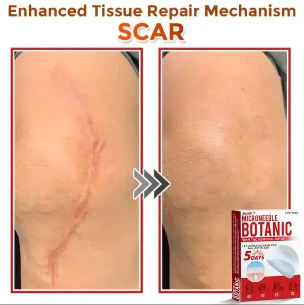 Removal Patch: Gentle Microneedle Patches for Skin Tag & Mole Removal - Image 11