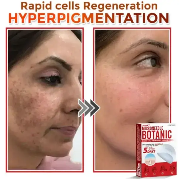 Removal Patch: Gentle Microneedle Patches for Skin Tag & Mole Removal - Image 6