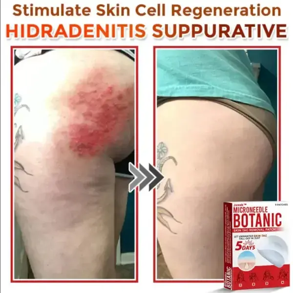 Removal Patch: Gentle Microneedle Patches for Skin Tag & Mole Removal - Image 9