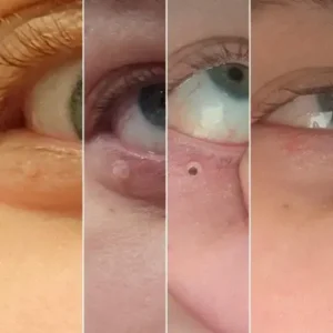 Alternative view of – Skin Wart & Skin Tag Removal Kit