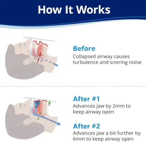 Anti-Snoring Mouthpiece - Image 2