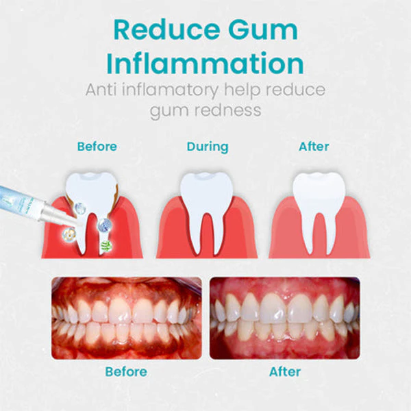 Gum Shield Therapy Gel - Image 6