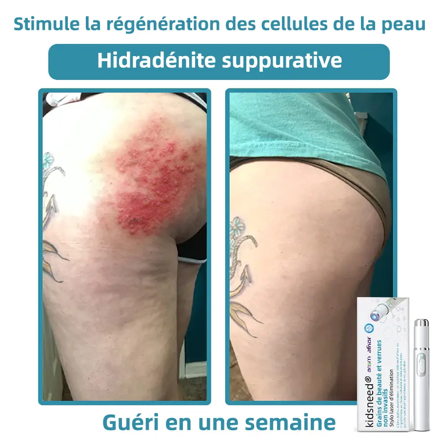 Grains de beauté et verrues non invasifs Stylo laser d'élimination - Image 12
