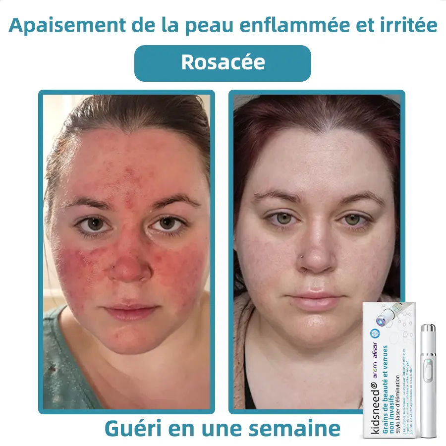 Grains de beauté et verrues non invasifs Stylo laser d'élimination - Image 7