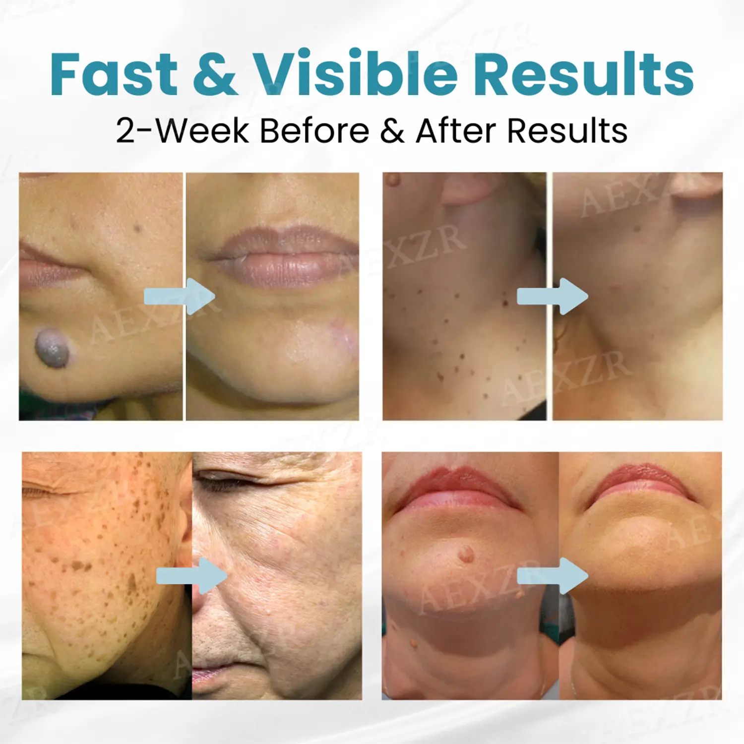 PRO Non-Invasive Mole and Wart Removal Laser Pen - Image 2
