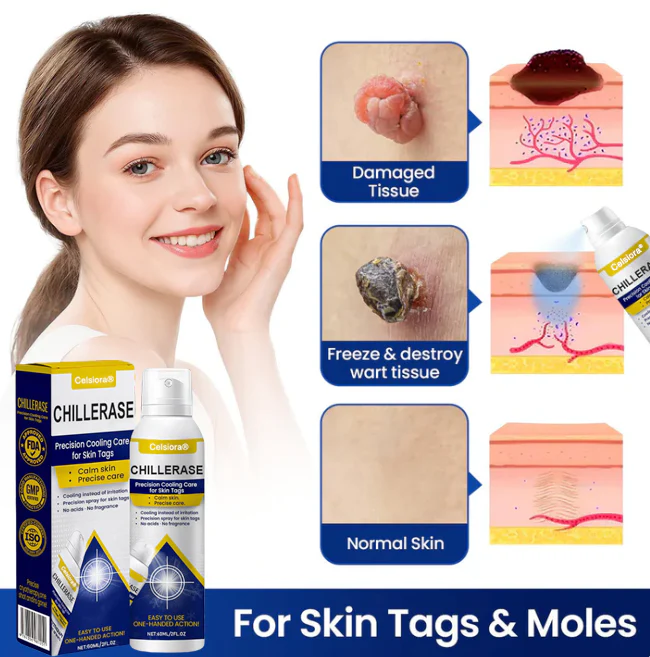 ChillErase Cooling Spray for Skin Tags - Image 3