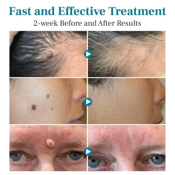 LumeSkin Mole and Wart Removal Laser Pen - Image 10