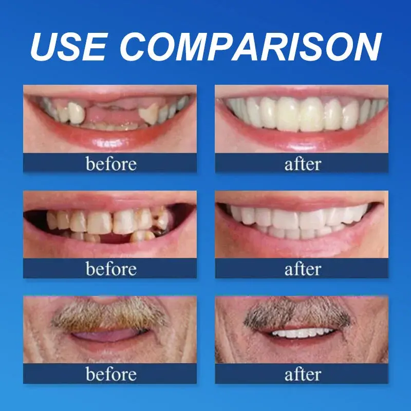 Advanced Customized Full Denture Set - Image 12