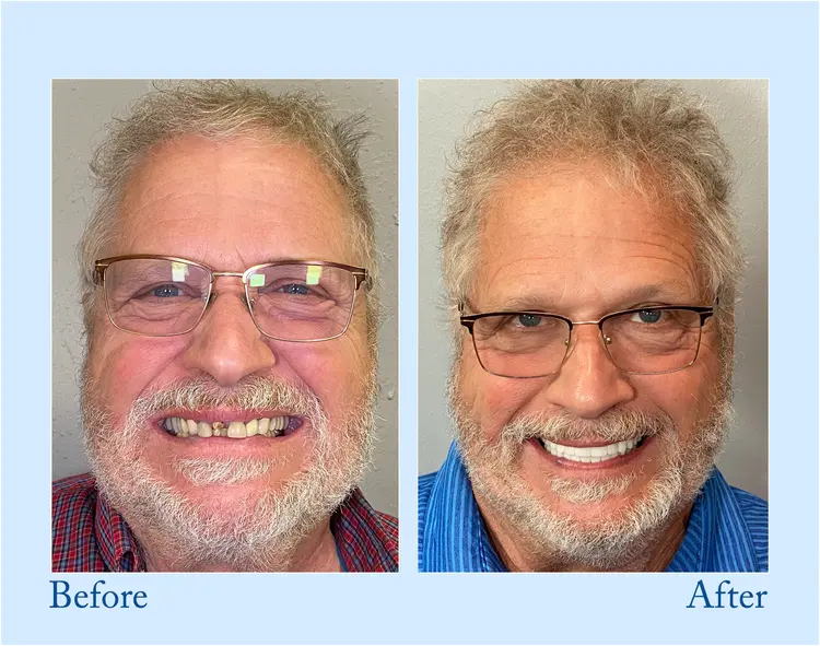 Fluoride-Free Hydroxyapatite Toothpaste - Image 5
