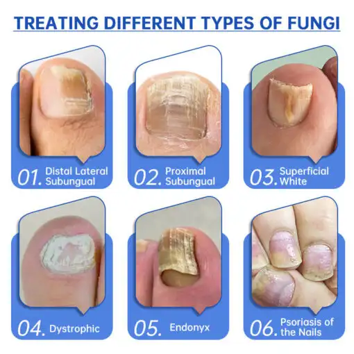 Advanced PureNail Fungus Laser Device - Image 10