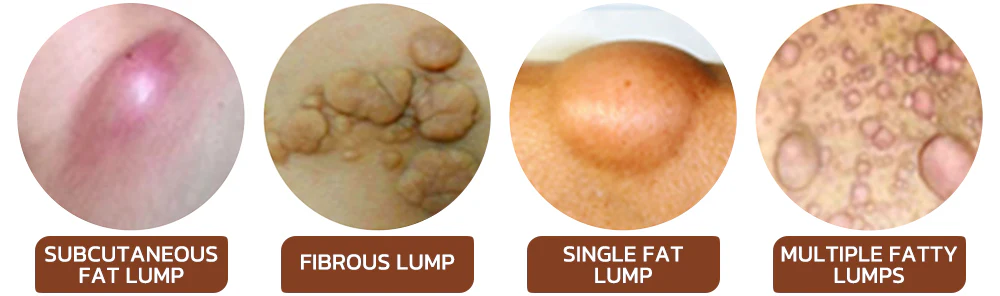 Lumpless Lipoma Treatment Cream - Image 2
