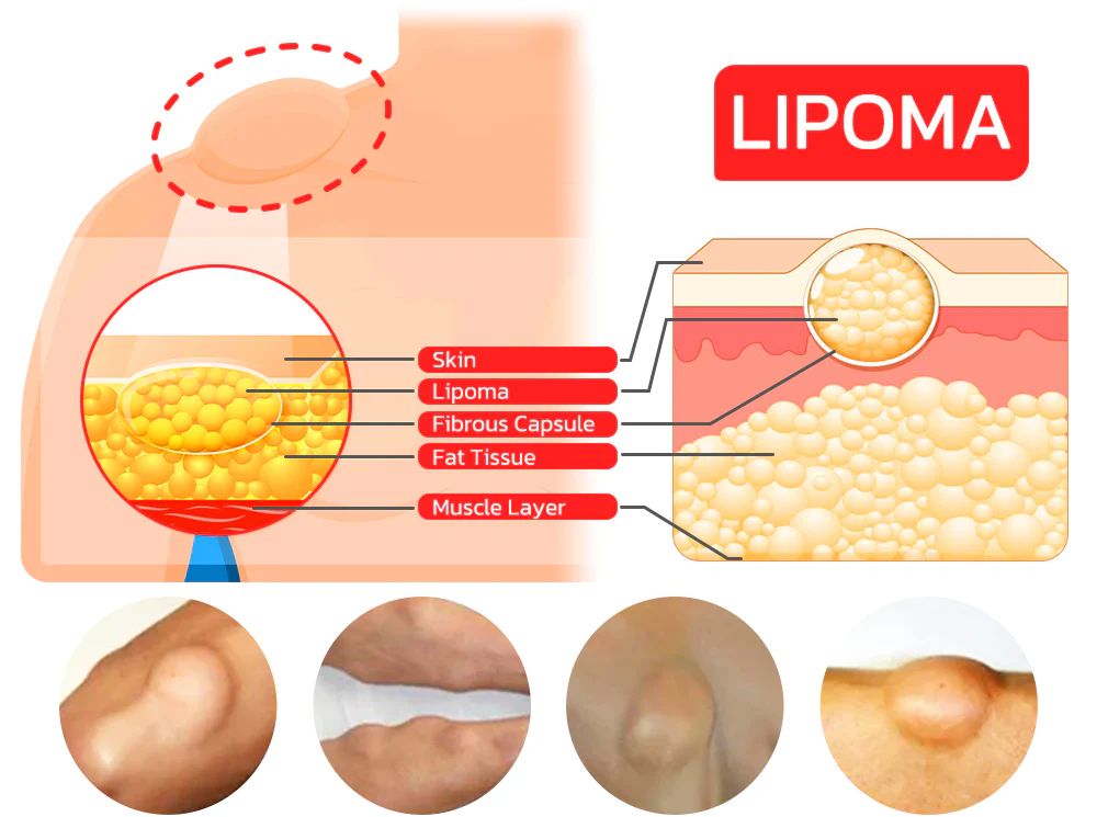 Lumpless Lipoma Treatment Cream - Image 9