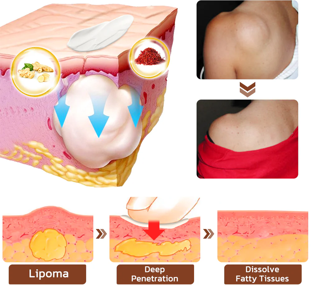 Lumpless Lipoma Treatment Cream - Image 10