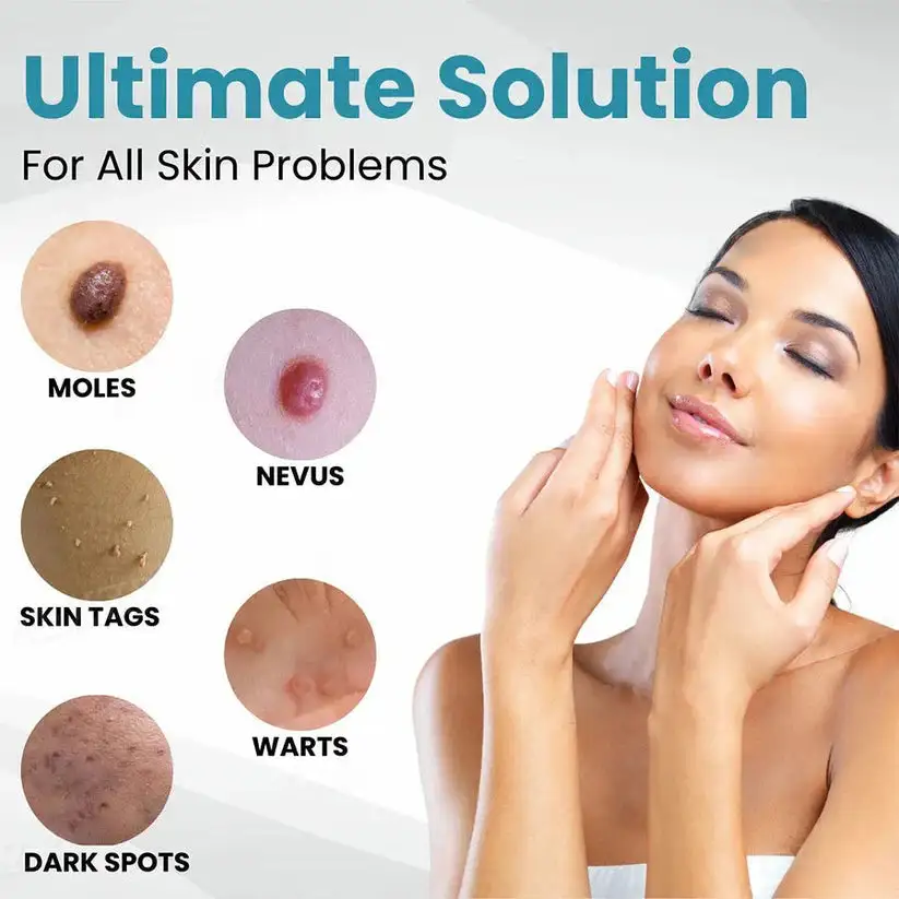Non-Invasive Mole and Wart Removal Laser Pen - Image 9