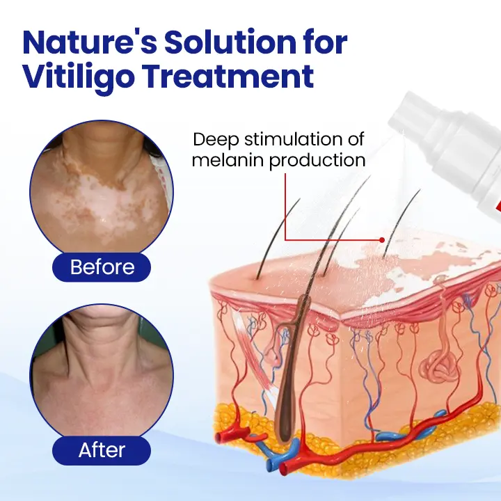 Vitiligo Spray: Psoralen-Powered Relief for White Spots & Irritation - Image 2