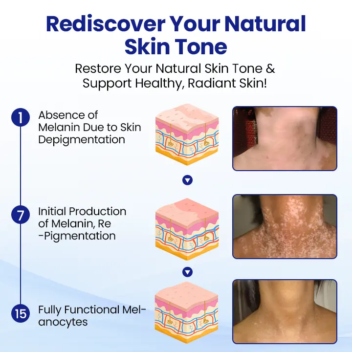 Vitiligo Spray: Psoralen-Powered Relief for White Spots & Irritation - Image 4
