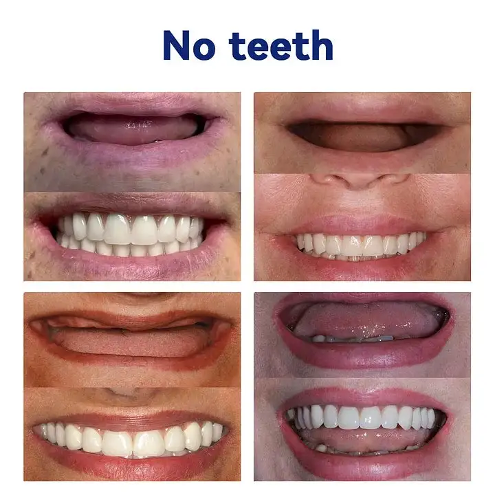 Advanced Customized Full Denture Set - Image 5