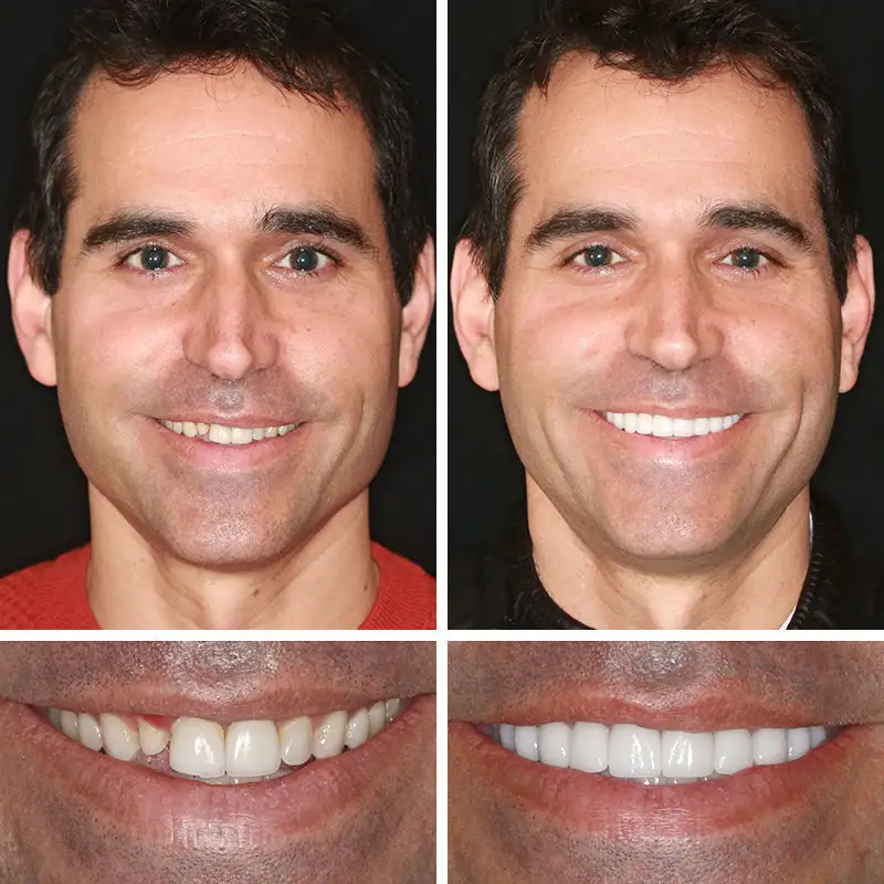 Advanced Customized Full Denture Set - Image 6