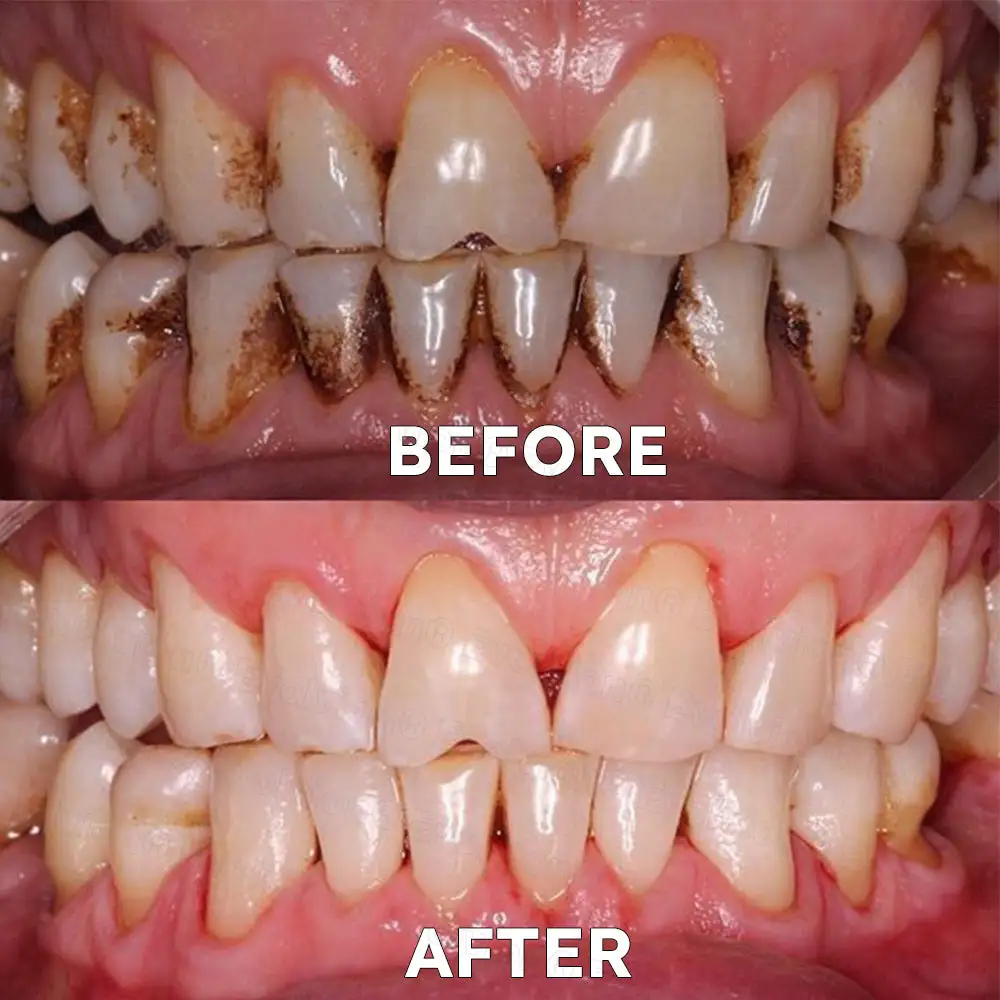 Fluoride-Free Nano Hydroxyapatite Tooth Powder - Image 7