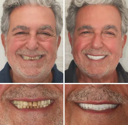 Custom-Fit Functional Denture - Image 3