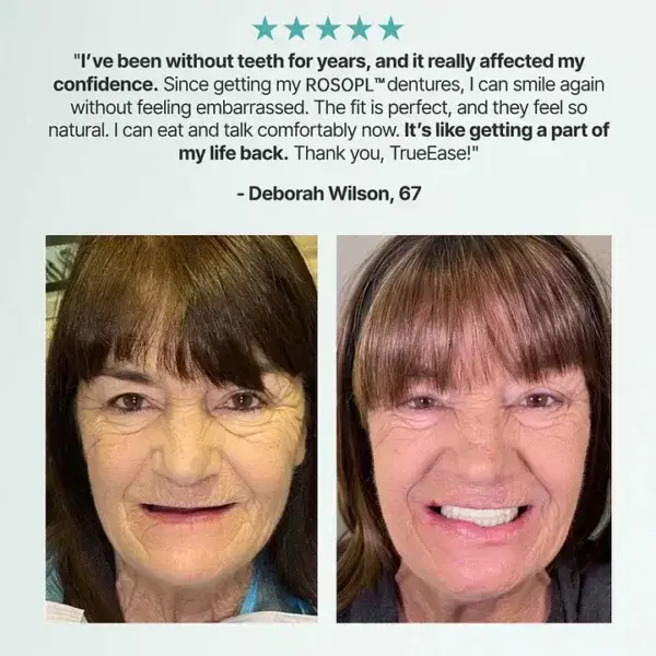 Custom-Fit Functional Dentures - Image 5
