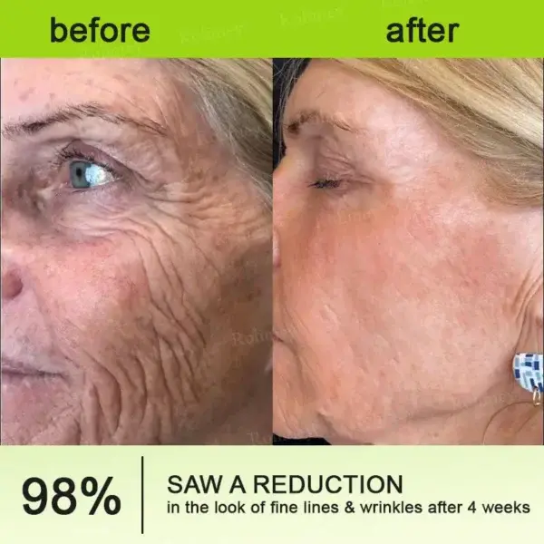 Botox & Vita-A Retinol Shot - Image 11