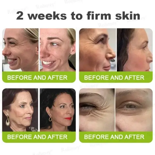Botox & Vita-A Retinol Shot - Image 7