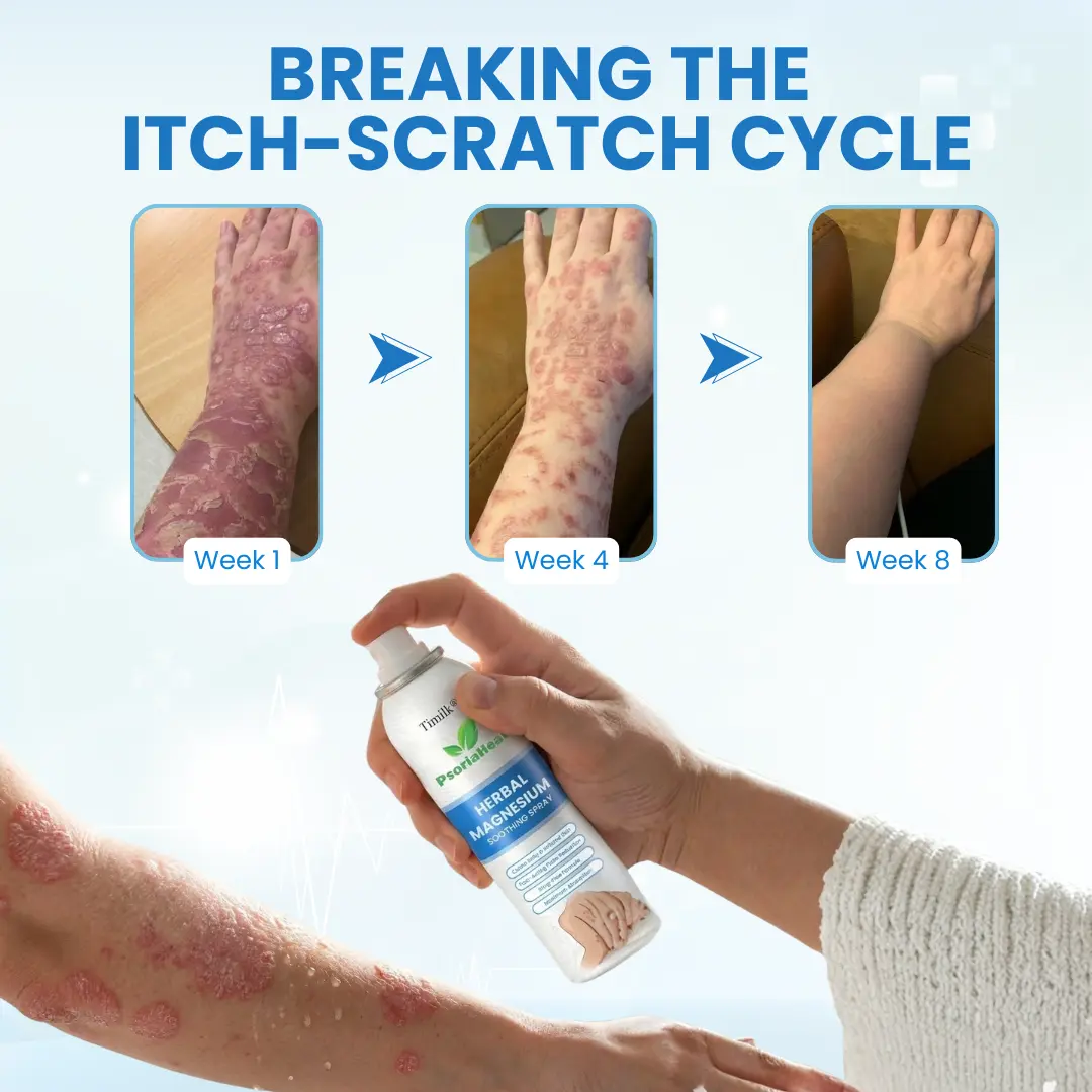 PsoriaHeal Herbal Magnesium Soothing Spray - Image 4