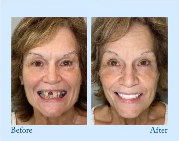 Custom-Fit Functional Dentures — Perfectly Fitted in Minutes at Home - Image 10